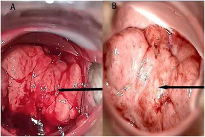 Case report: A rare case of malacoplakia resembling a malignant tumor of the cervix: a case report and review of the literature